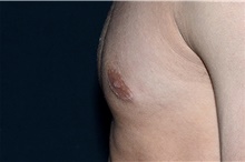 Male Breast Reduction After Photo by Landon Pryor, MD, FACS; Rockford, IL - Case 38810