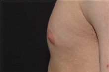 Male Breast Reduction Before Photo by Landon Pryor, MD, FACS; Rockford, IL - Case 38810