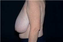Breast Reduction Before Photo by Landon Pryor, MD, FACS; Rockford, IL - Case 38841