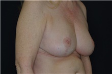 Breast Reduction After Photo by Landon Pryor, MD, FACS; Rockford, IL - Case 38841