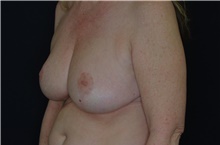 Breast Reduction After Photo by Landon Pryor, MD, FACS; Rockford, IL - Case 38841