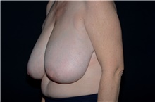 Breast Reduction Before Photo by Landon Pryor, MD, FACS; Rockford, IL - Case 38841
