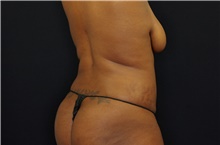 Body Contouring After Photo by Landon Pryor, MD, FACS; Rockford, IL - Case 38842