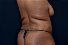 Body Contouring Before Photo by Landon Pryor, MD, FACS; Rockford, IL - Case 38842