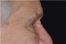Eyelid Surgery After Photo by Landon Pryor, MD, FACS; Rockford, IL - Case 38844