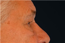 Eyelid Surgery Before Photo by Landon Pryor, MD, FACS; Rockford, IL - Case 38844