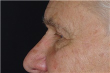 Eyelid Surgery After Photo by Landon Pryor, MD, FACS; Rockford, IL - Case 38844