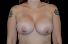 Breast Augmentation After Photo by Landon Pryor, MD, FACS; Rockford, IL - Case 38845