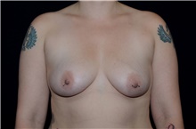 Breast Augmentation Before Photo by Landon Pryor, MD, FACS; Rockford, IL - Case 38845