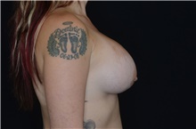 Breast Augmentation After Photo by Landon Pryor, MD, FACS; Rockford, IL - Case 38845