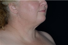 Liposuction After Photo by Landon Pryor, MD, FACS; Rockford, IL - Case 38897