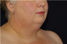 Liposuction Before Photo by Landon Pryor, MD, FACS; Rockford, IL - Case 38897
