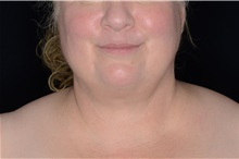 Liposuction After Photo by Landon Pryor, MD, FACS; Rockford, IL - Case 38897