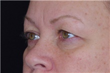 Eyelid Surgery Before Photo by Landon Pryor, MD, FACS; Rockford, IL - Case 38908