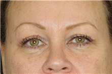 Eyelid Surgery After Photo by Landon Pryor, MD, FACS; Rockford, IL - Case 38908