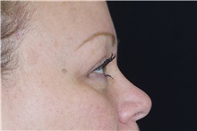 Eyelid Surgery After Photo by Landon Pryor, MD, FACS; Rockford, IL - Case 38908