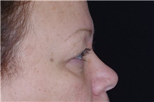 Eyelid Surgery Before Photo by Landon Pryor, MD, FACS; Rockford, IL - Case 38908