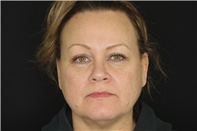 Brow Lift After Photo by Landon Pryor, MD, FACS; Rockford, IL - Case 38925