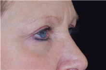 Eyelid Surgery After Photo by Landon Pryor, MD, FACS; Rockford, IL - Case 38926