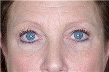 Eyelid Surgery Before Photo by Landon Pryor, MD, FACS; Rockford, IL - Case 38926