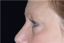Eyelid Surgery Before Photo by Landon Pryor, MD, FACS; Rockford, IL - Case 38926