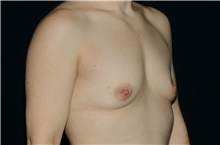 Breast Augmentation Before Photo by Landon Pryor, MD, FACS; Rockford, IL - Case 38927