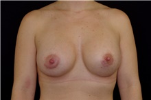 Breast Augmentation After Photo by Landon Pryor, MD, FACS; Rockford, IL - Case 38927