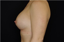 Breast Augmentation After Photo by Landon Pryor, MD, FACS; Rockford, IL - Case 38927
