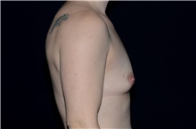 Breast Augmentation Before Photo by Landon Pryor, MD, FACS; Rockford, IL - Case 38927
