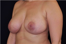 Breast Augmentation After Photo by Landon Pryor, MD, FACS; Rockford, IL - Case 38928