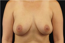 Breast Augmentation Before Photo by Landon Pryor, MD, FACS; Rockford, IL - Case 38928