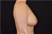 Breast Augmentation Before Photo by Landon Pryor, MD, FACS; Rockford, IL - Case 38928