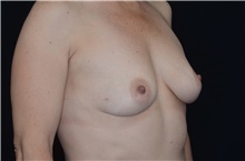 Breast Augmentation Before Photo by Landon Pryor, MD, FACS; Rockford, IL - Case 38947