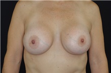 Breast Augmentation After Photo by Landon Pryor, MD, FACS; Rockford, IL - Case 38947