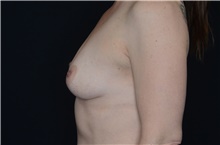 Breast Augmentation Before Photo by Landon Pryor, MD, FACS; Rockford, IL - Case 38947