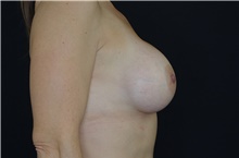 Breast Augmentation After Photo by Landon Pryor, MD, FACS; Rockford, IL - Case 38947