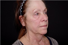 Brow Lift Before Photo by Landon Pryor, MD, FACS; Rockford, IL - Case 38958