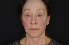 Brow Lift After Photo by Landon Pryor, MD, FACS; Rockford, IL - Case 38958
