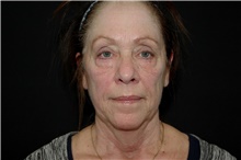 Facelift Before Photo by Landon Pryor, MD, FACS; Rockford, IL - Case 38962
