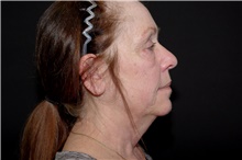 Facelift Before Photo by Landon Pryor, MD, FACS; Rockford, IL - Case 38962