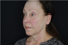 Injectable Fillers and Fat Transfer to the Face After Photo by Landon Pryor, MD, FACS; Rockford, IL - Case 38963