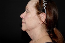 Injectable Fillers and Fat Transfer to the Face Before Photo by Landon Pryor, MD, FACS; Rockford, IL - Case 38963