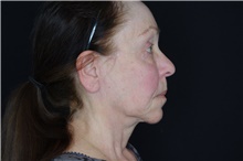 Injectable Fillers and Fat Transfer to the Face After Photo by Landon Pryor, MD, FACS; Rockford, IL - Case 38963