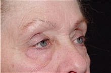 Eyelid Surgery Before Photo by Landon Pryor, MD, FACS; Rockford, IL - Case 38965