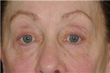 Eyelid Surgery After Photo by Landon Pryor, MD, FACS; Rockford, IL - Case 38965