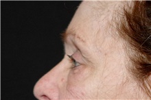 Eyelid Surgery Before Photo by Landon Pryor, MD, FACS; Rockford, IL - Case 38965