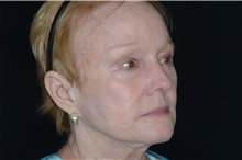 Thread Lift After Photo by Landon Pryor, MD, FACS; Rockford, IL - Case 38984