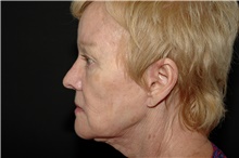 Injectable Fillers Before Photo by Landon Pryor, MD, FACS; Rockford, IL - Case 38985