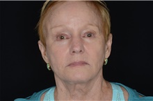Brow Lift After Photo by Landon Pryor, MD, FACS; Rockford, IL - Case 38986