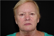 Brow Lift Before Photo by Landon Pryor, MD, FACS; Rockford, IL - Case 38986